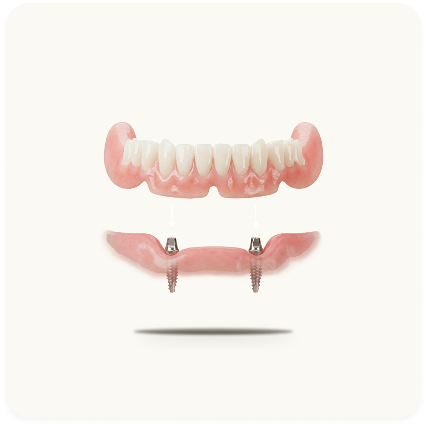 Implanted Dentures